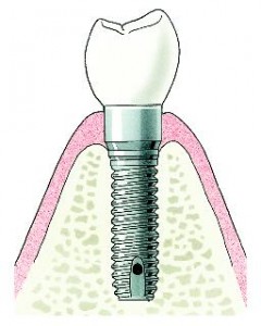 Implantaat en kroon